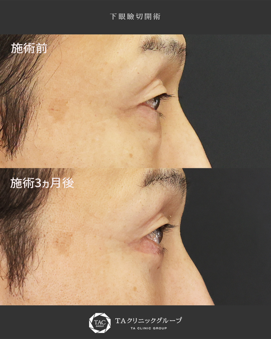 下眼瞼切開術（クマ・たるみとり）の症例写真 施術前後 