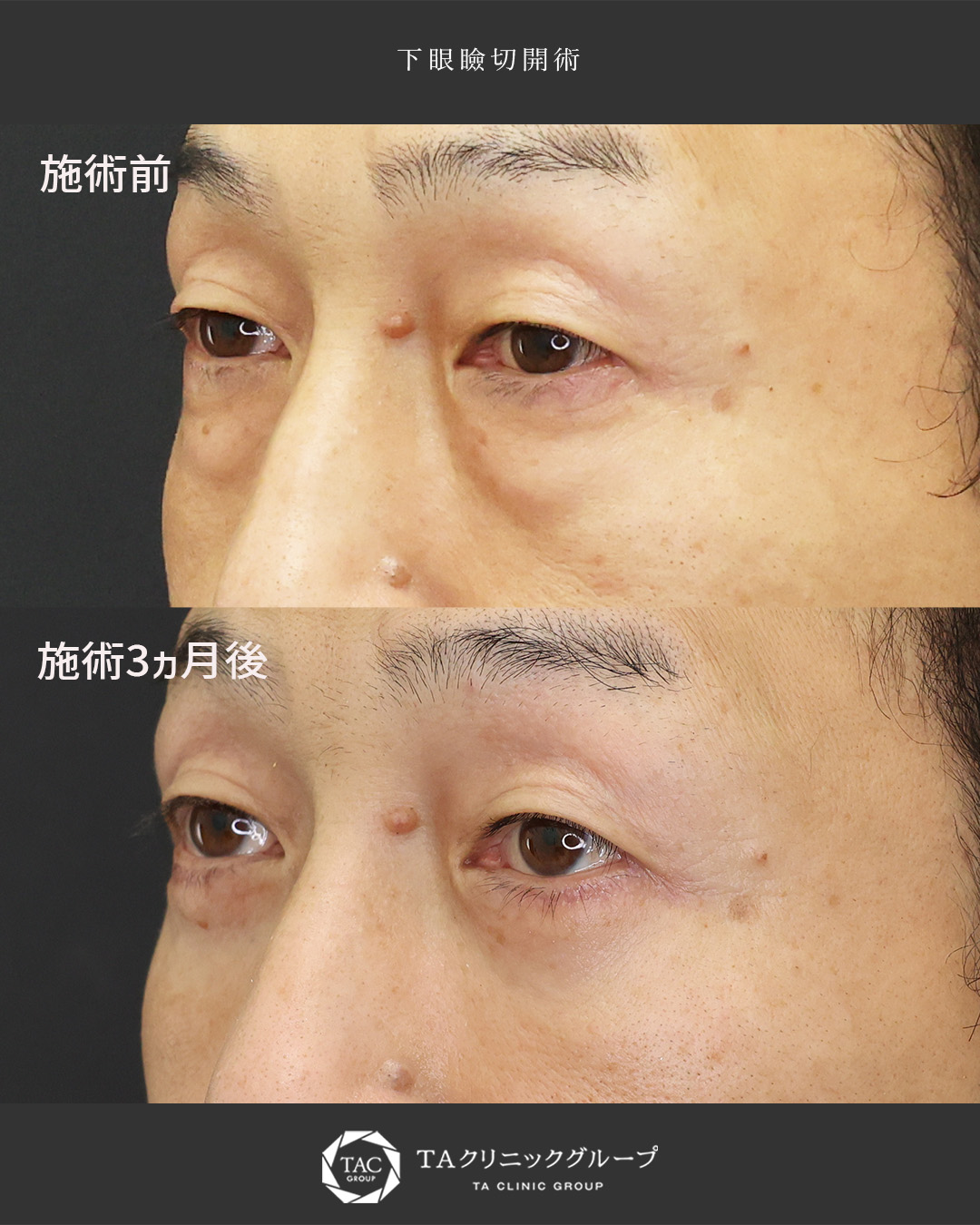 下眼瞼切開術（クマ・たるみとり）の症例写真 施術前後 