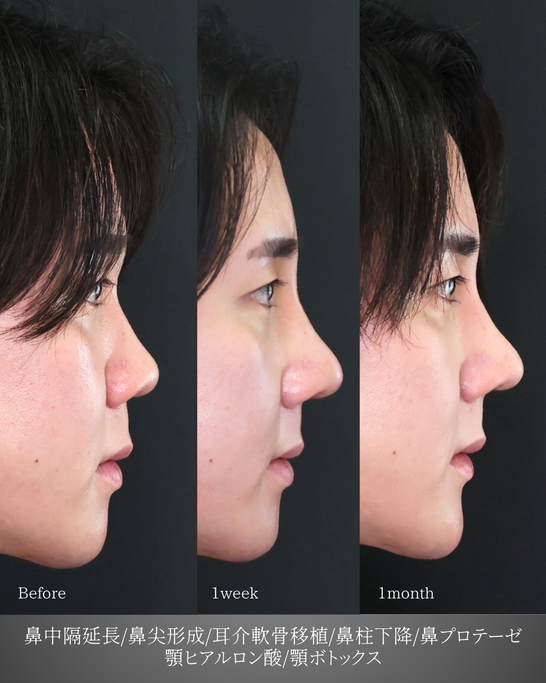 鼻中隔延長術/鼻尖形成・鼻尖縮小/隆鼻術（プロテーゼ・自家組織）の症例写真 施術前後 