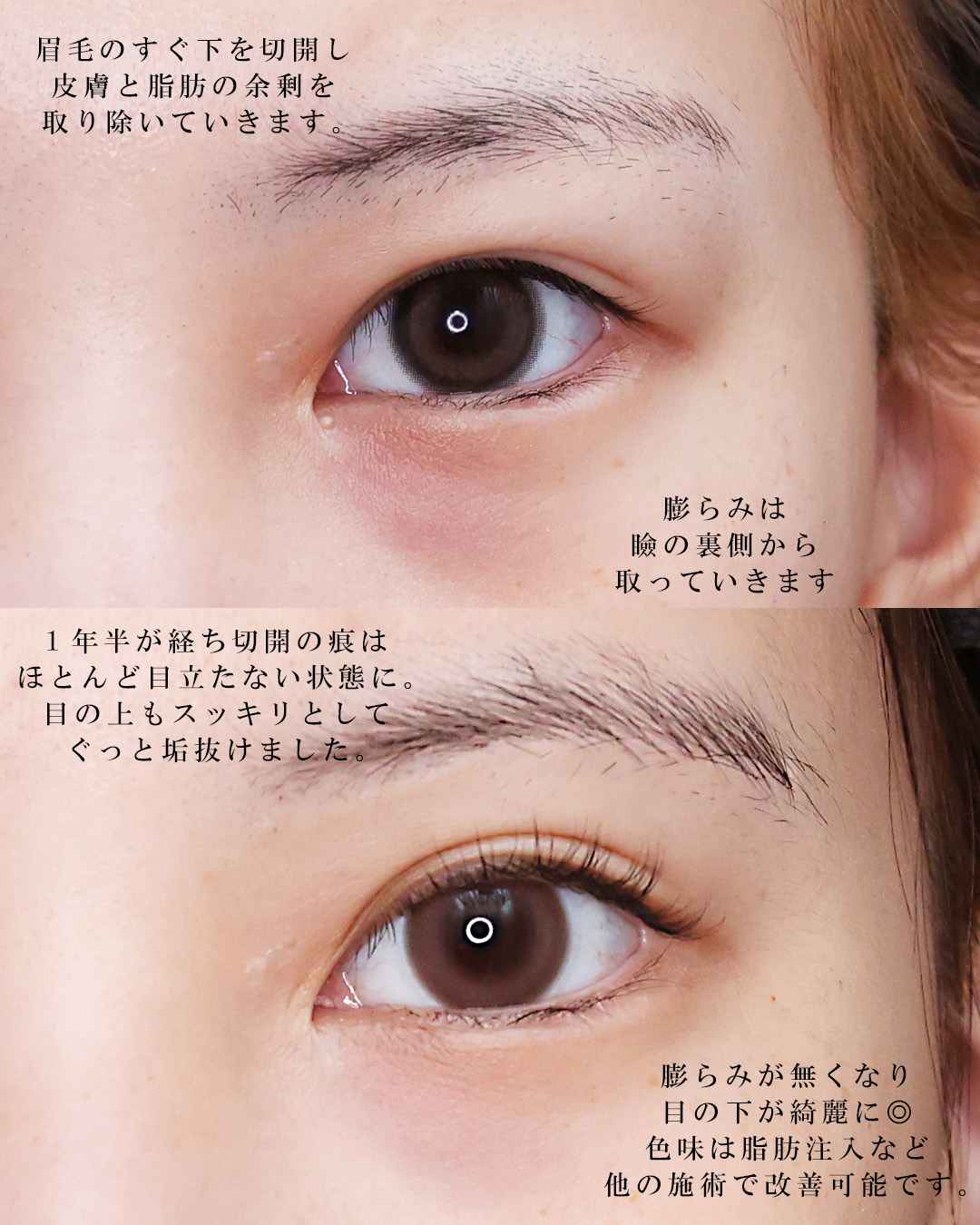 眉毛下切開術の症例写真 施術前後 