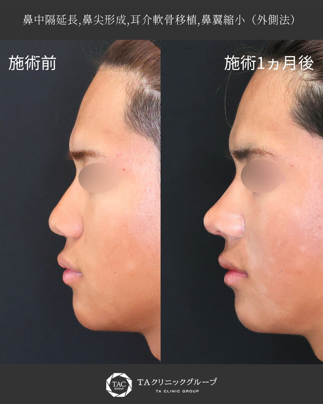 【メンズ鼻整形】鼻を整えて顔全体の印象も整える◎