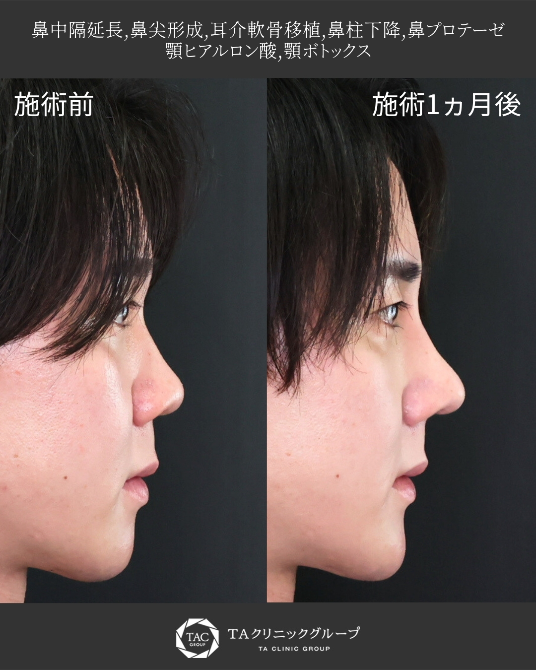 【メンズ鼻整形】鼻の丸み改善でイケメン度アップ