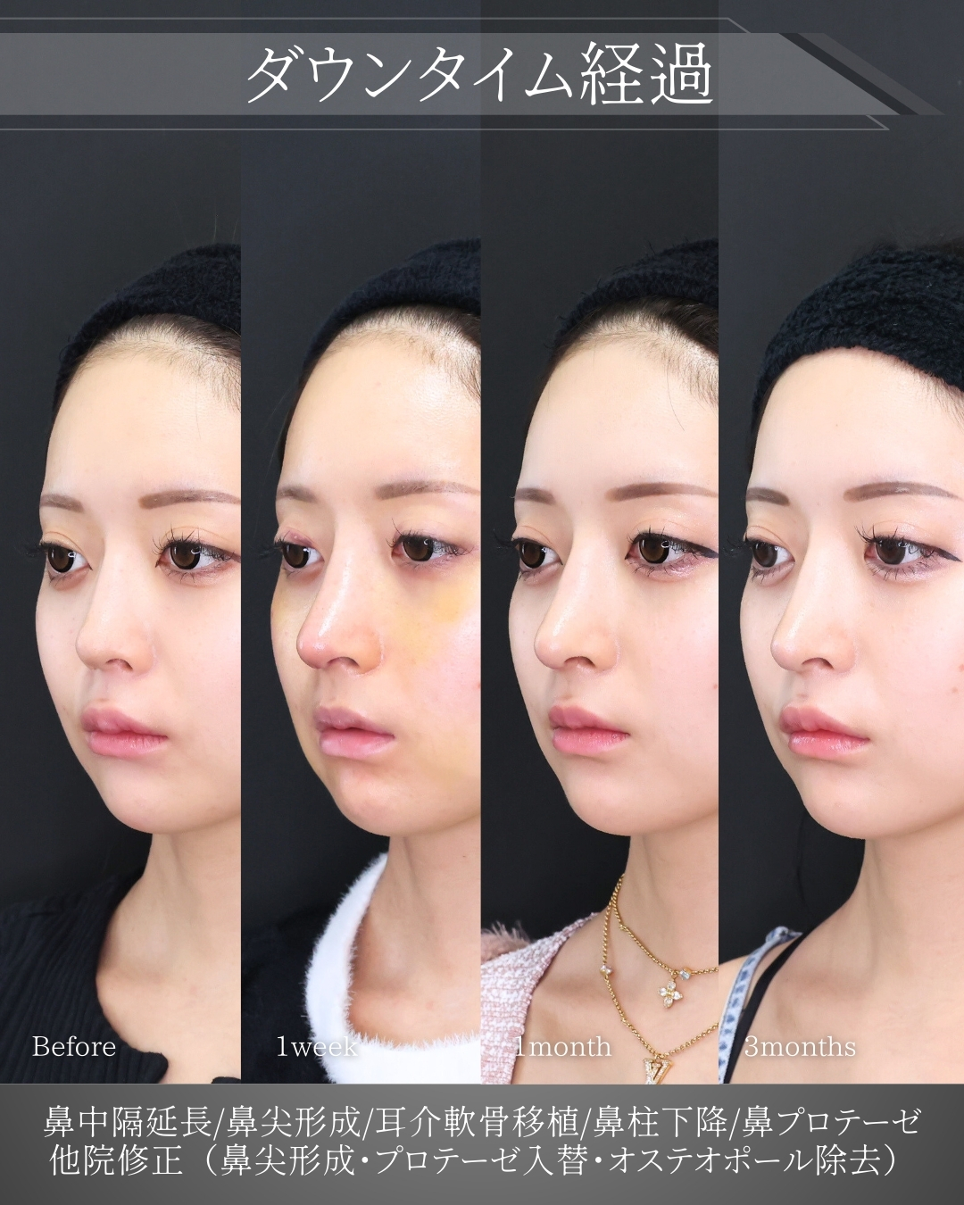 鼻中隔延長術/鼻尖形成・鼻尖縮小/鼻先軟骨移植の症例写真 施術前後 