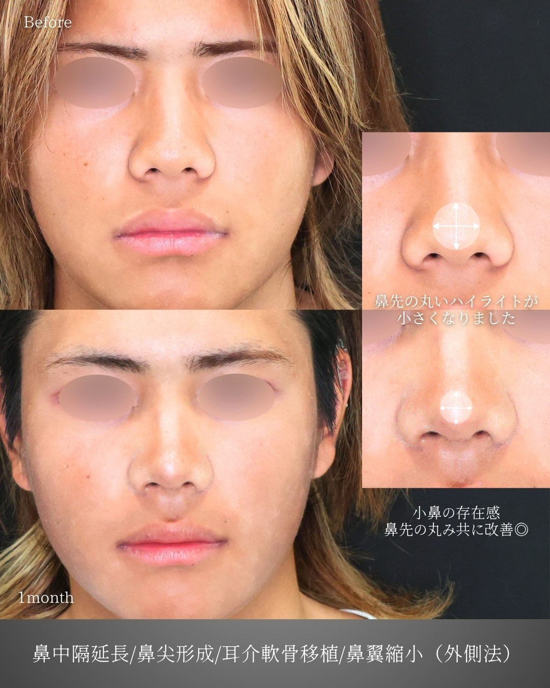 鼻中隔延長術/鼻尖形成・鼻尖縮小/TAC式 鼻翼縮小術（小鼻縮小）の症例写真 施術前後 