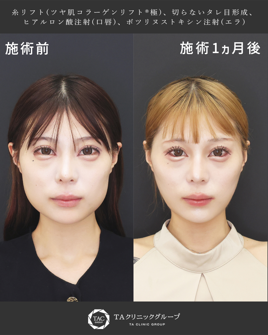 エラ張りを改善し、切らないたれ目形成で【別人級の垢抜け】札幌の形成外科専門医執刀