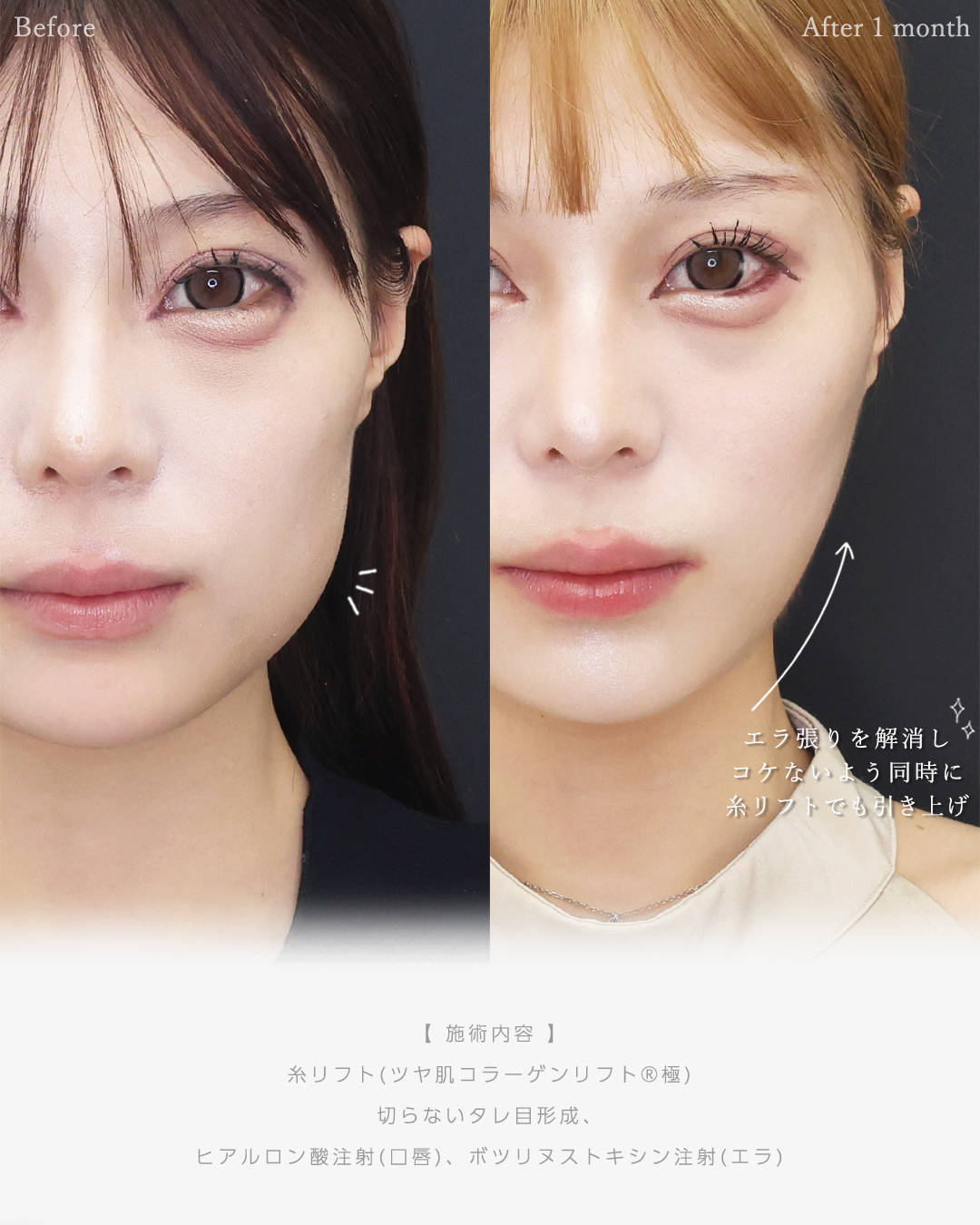 TAC式 ツヤ肌コラーゲンリフト®/グラマラスライン（タレ目形成）/エラボトックス注射の症例写真 施術前後 