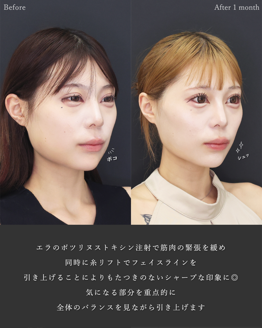 TAC式 ツヤ肌コラーゲンリフト®/グラマラスライン（タレ目形成）/エラボトックス注射の症例写真 施術前後 