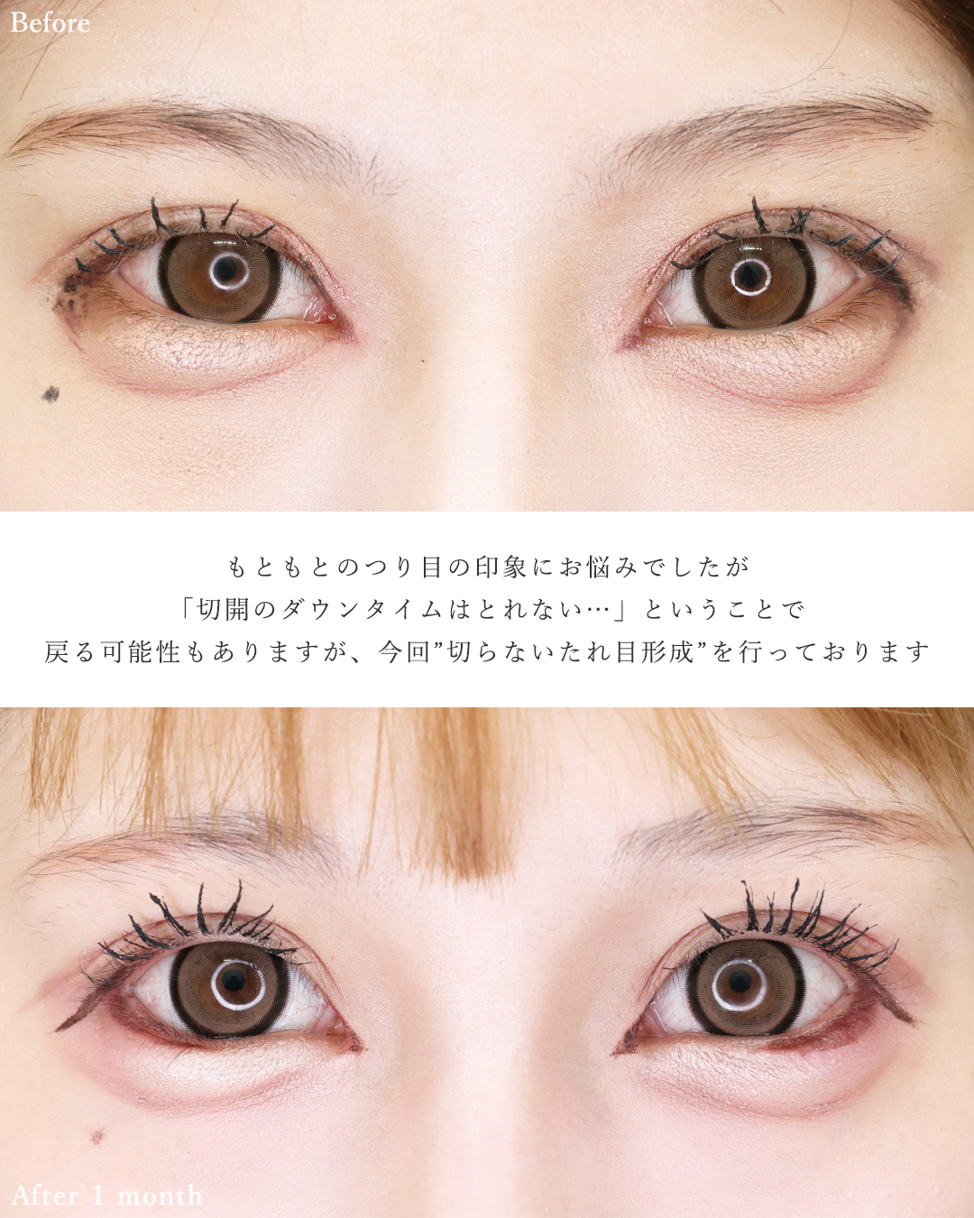 TAC式 ツヤ肌コラーゲンリフト®/グラマラスライン（タレ目形成）/エラボトックス注射の症例写真 施術前後 