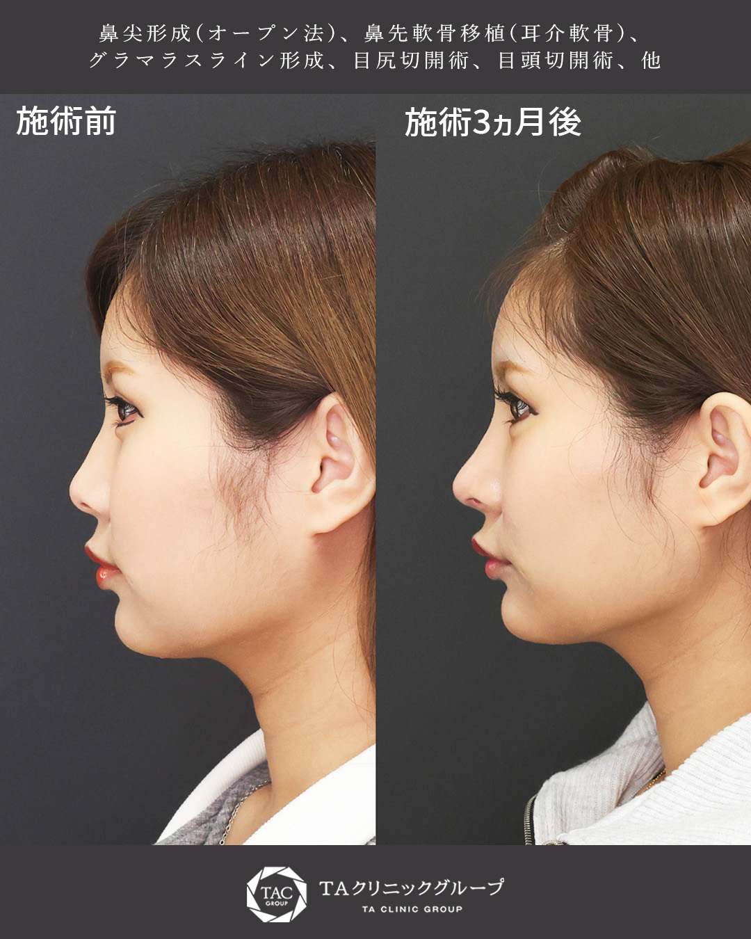 形成外科専門医がおこなう複合美容整形【目元切開×鼻整形】