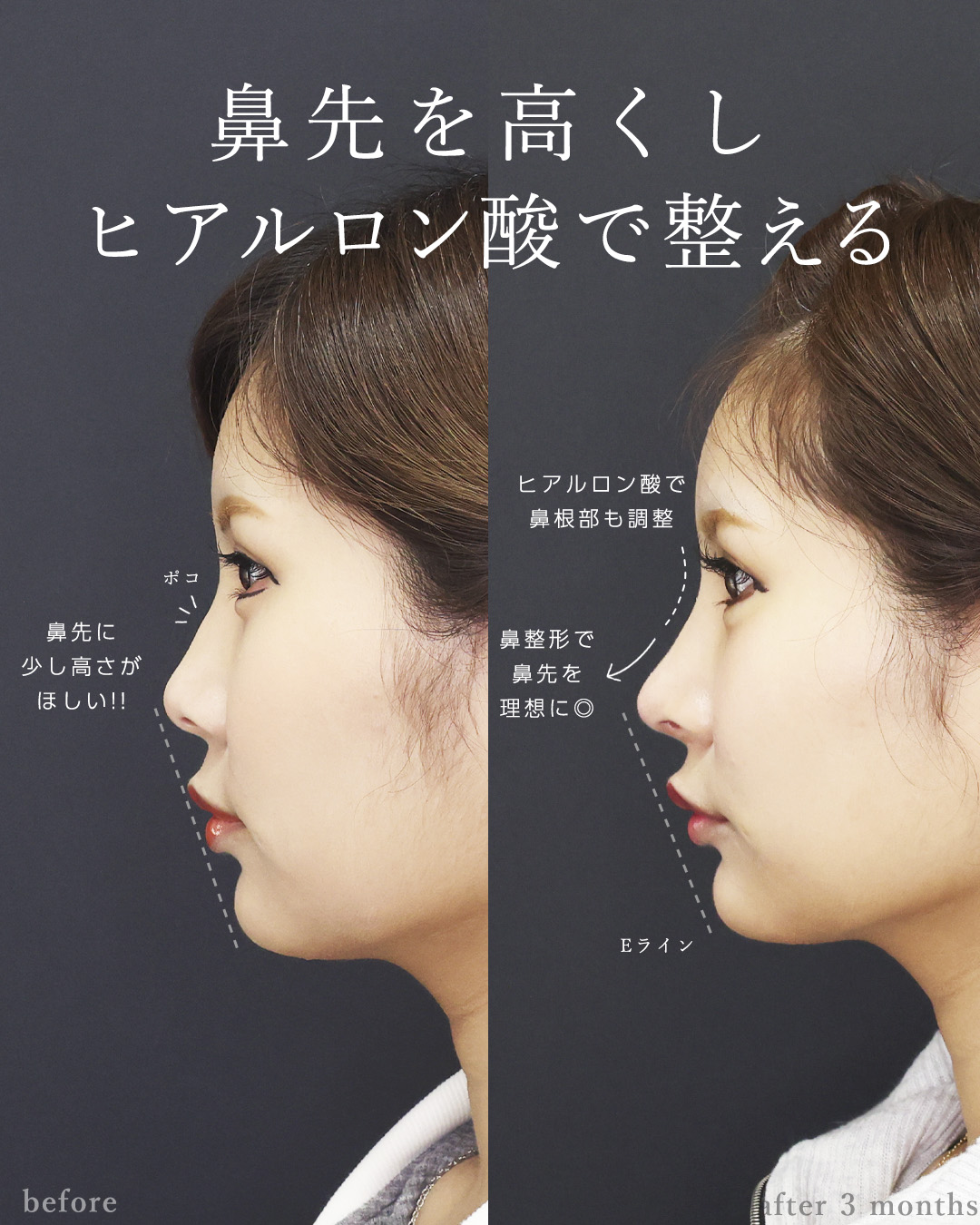 鼻尖形成・鼻尖縮小/鼻先軟骨移植/グラマラスライン（タレ目形成）の症例写真 施術前後 