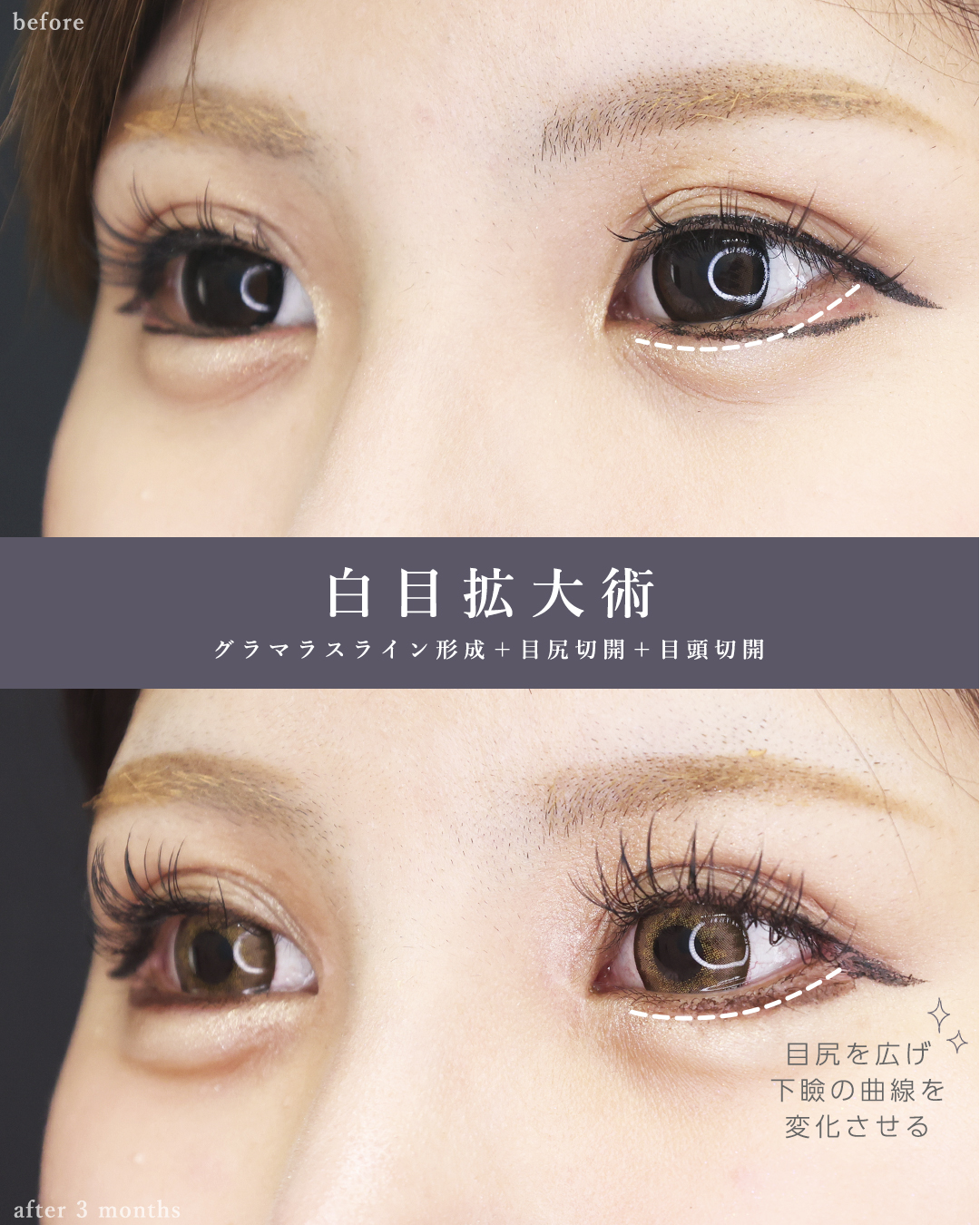 鼻尖形成・鼻尖縮小/鼻先軟骨移植/グラマラスライン（タレ目形成）の症例写真 施術前後 