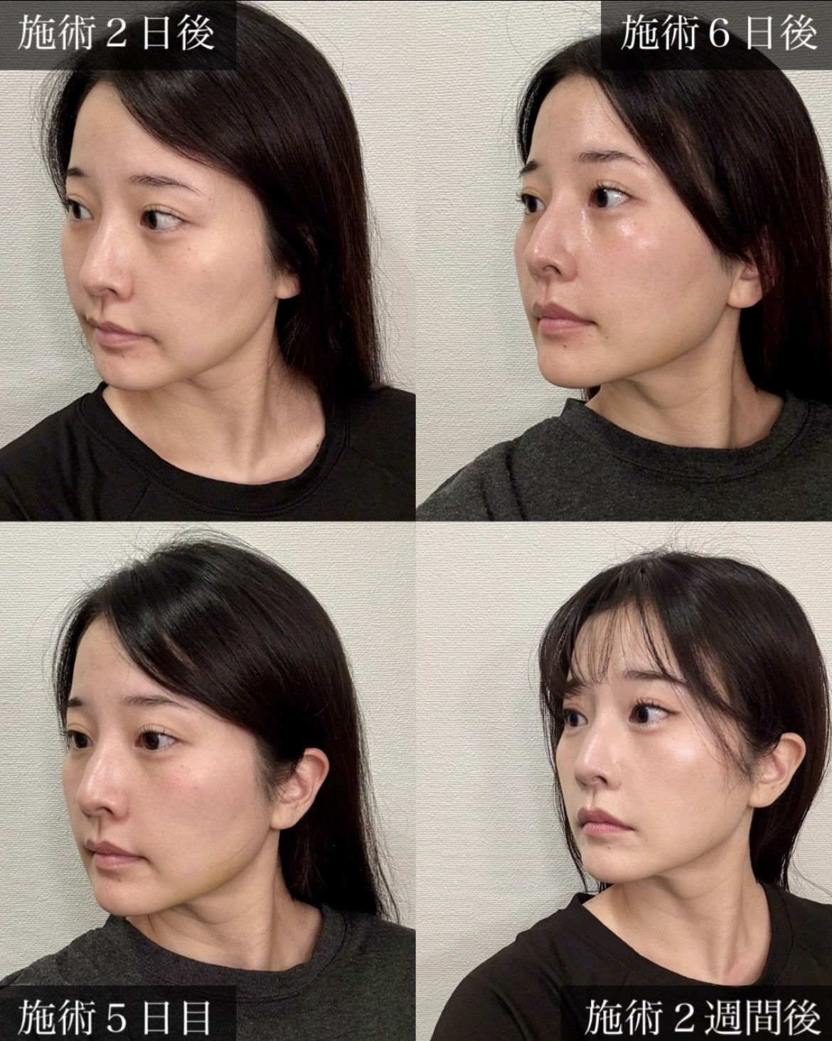 TAC式 ツヤ肌コラーゲンリフト®/ジョールファット除去/エラボトックス注射の症例写真 施術前後 