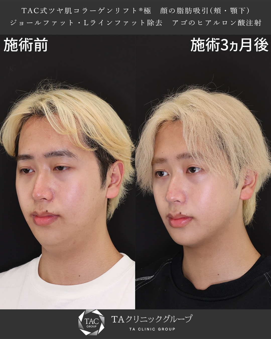 【メンズ整形】フェイスラインを完全にスッキリ！Dr.もりもりの小顔脂肪吸引