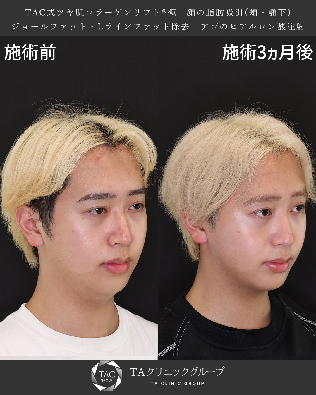 TAC式 ツヤ肌コラーゲンリフト®/Lラインファット除去（エラ下脂肪除去）/顔の脂肪吸引の症例写真 施術前後 