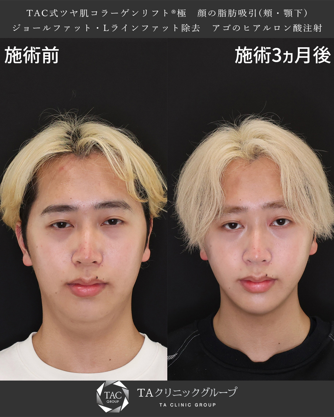 TAC式 ツヤ肌コラーゲンリフト®/Lラインファット除去（エラ下脂肪除去）/顔の脂肪吸引の症例写真 施術前後 