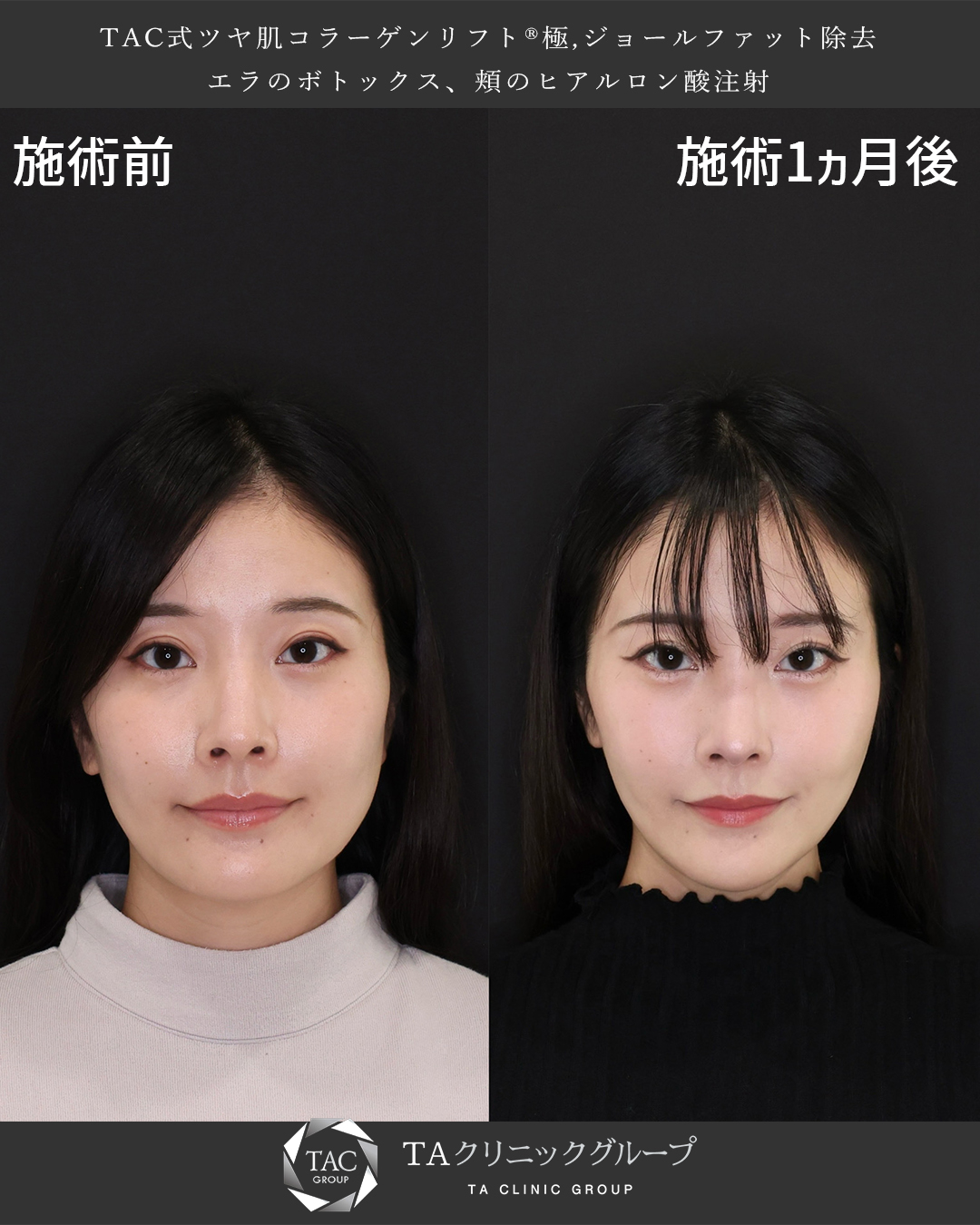 【バチェラー】2度出演の松木星良さんも卵型フェイスラインに！