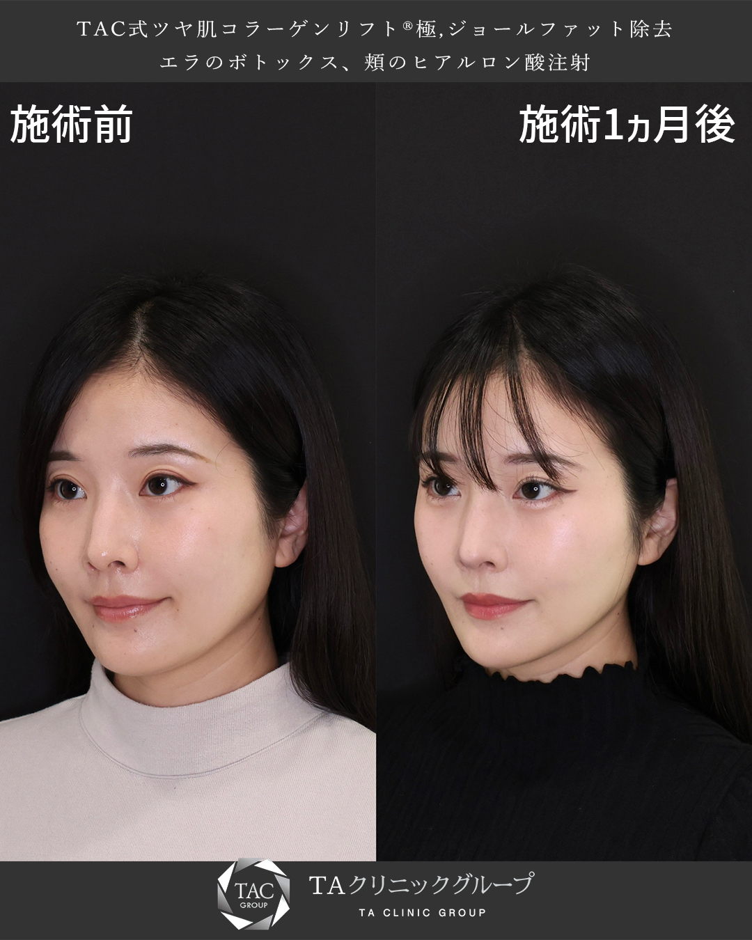 TAC式 ツヤ肌コラーゲンリフト®/ジョールファット除去/エラボトックス注射の症例写真 施術前後 