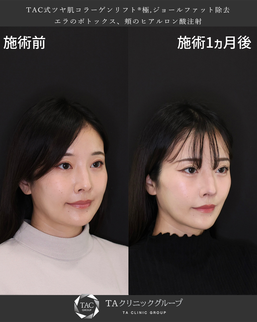 TAC式 ツヤ肌コラーゲンリフト®/ジョールファット除去/エラボトックス注射の症例写真 施術前後 