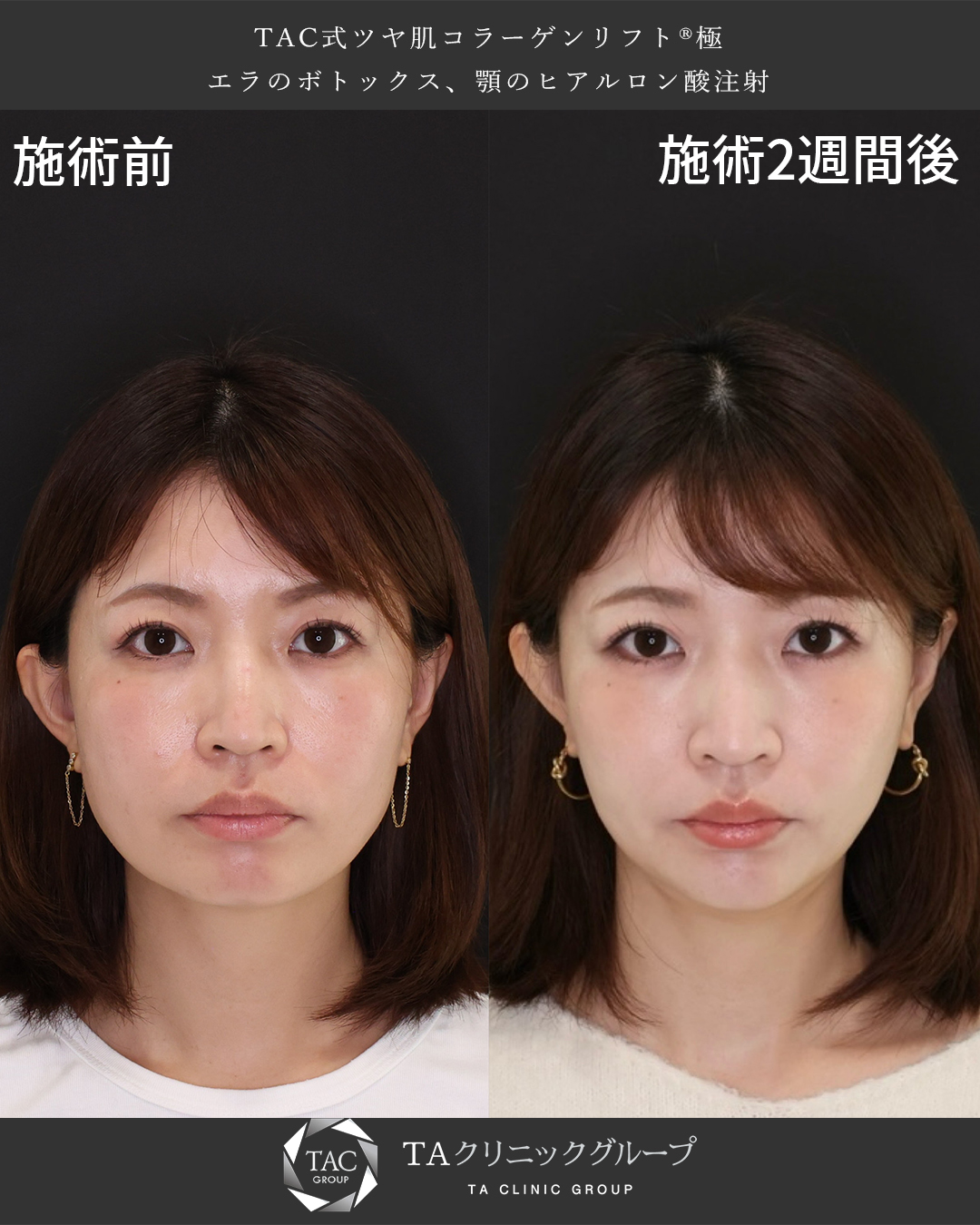 あいのりくうさんご来院！バレずにリフトアップ