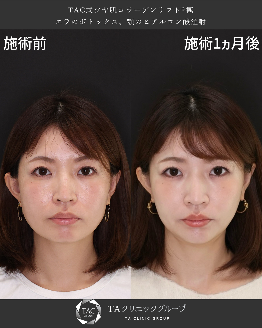 あいのりくうさんご来院！バレずにリフトアップ