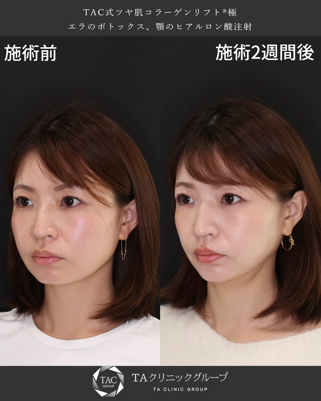 TAC式 ツヤ肌コラーゲンリフト®/エラボトックス注射/顎のヒアルロン酸注射の症例写真 施術前後 