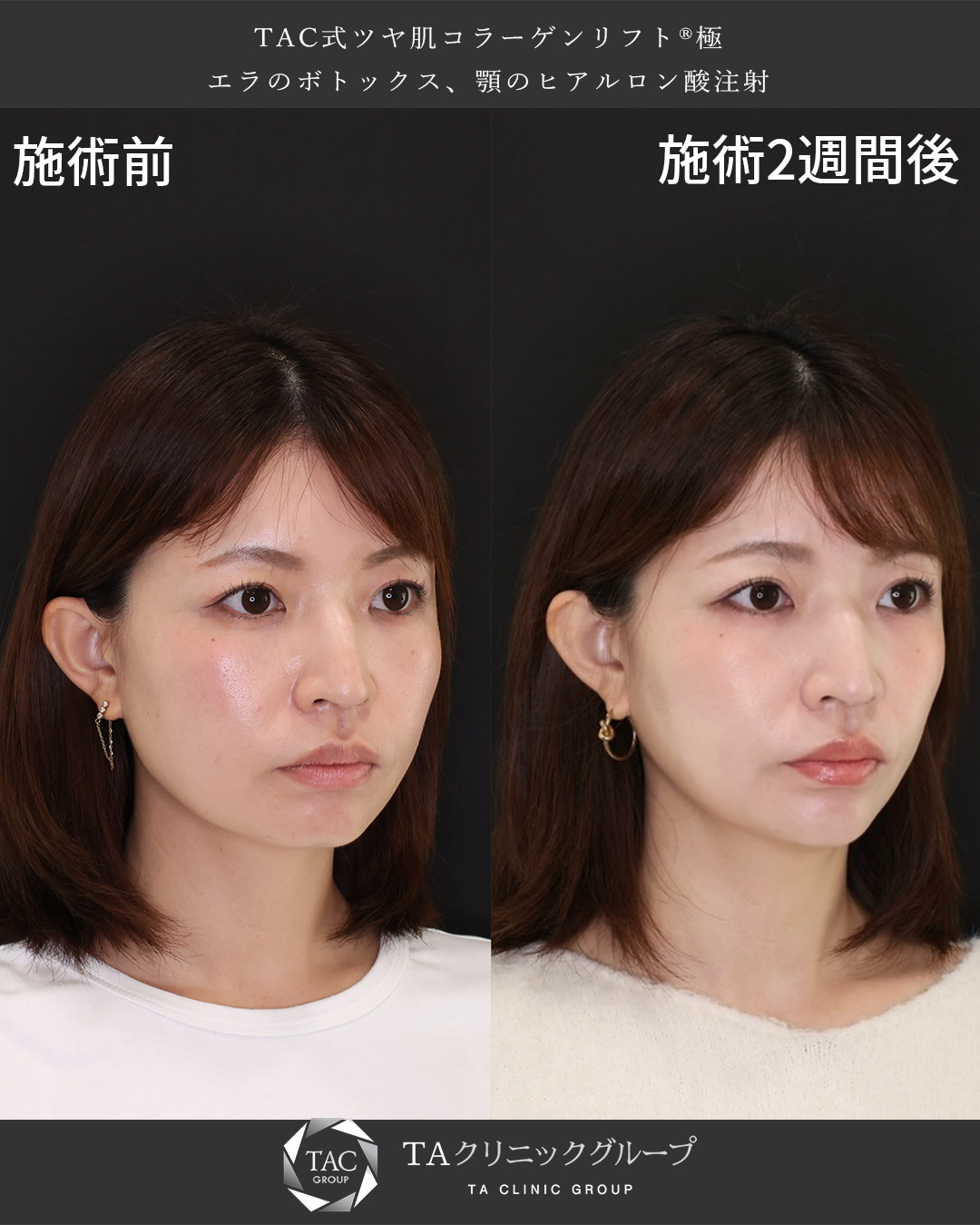 TAC式 ツヤ肌コラーゲンリフト®/エラボトックス注射/顎のヒアルロン酸注射の症例写真 施術前後 