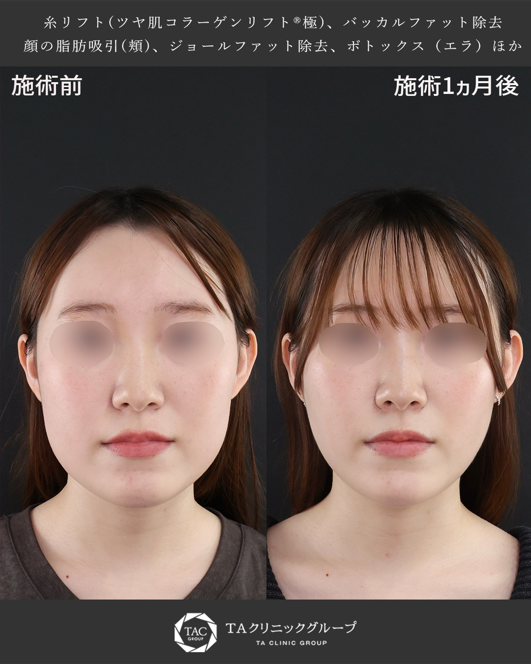 バッカルファット除去/ジョールファット除去/顔の脂肪吸引の症例写真 施術前後 