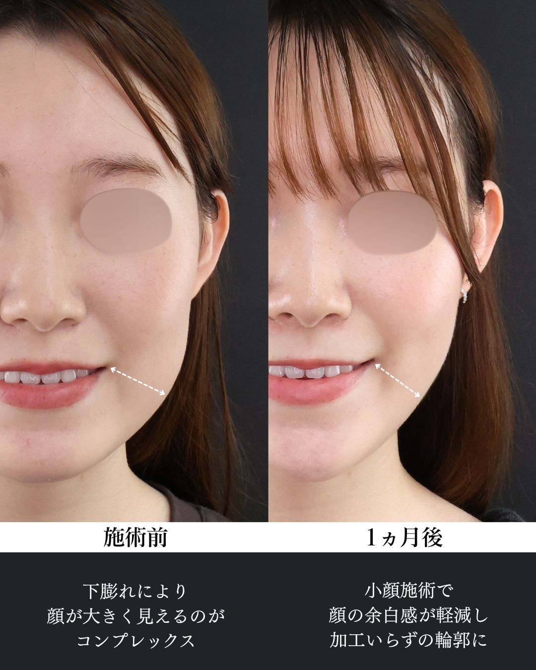 バッカルファット除去/ジョールファット除去/顔の脂肪吸引の症例写真 施術前後 