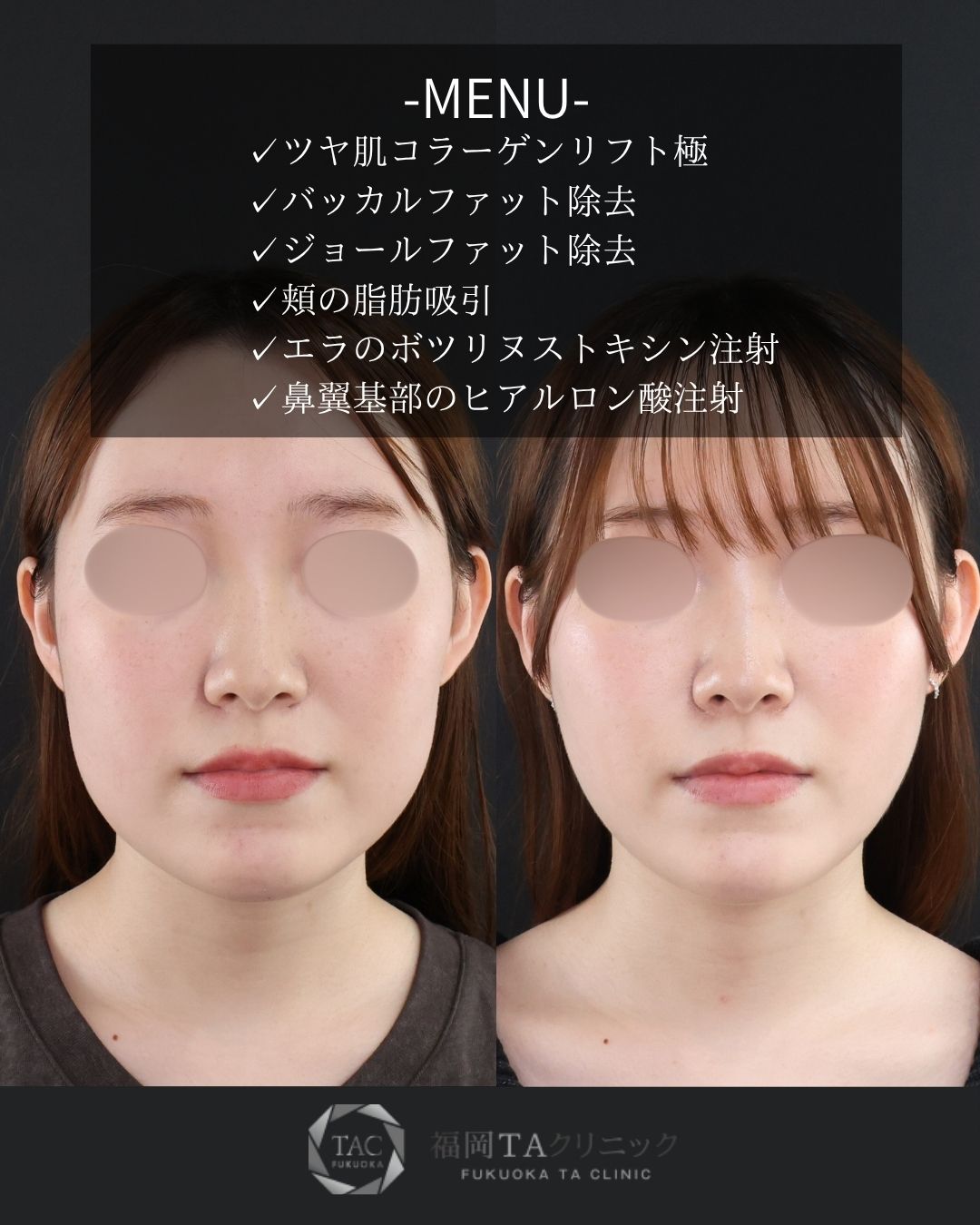 バッカルファット除去/ジョールファット除去/顔の脂肪吸引の症例写真 施術前後 