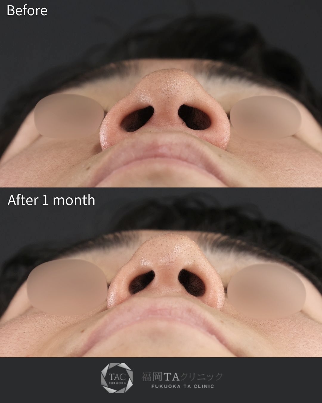 TAC式 鼻翼縮小術（小鼻縮小）の症例写真 施術前後 