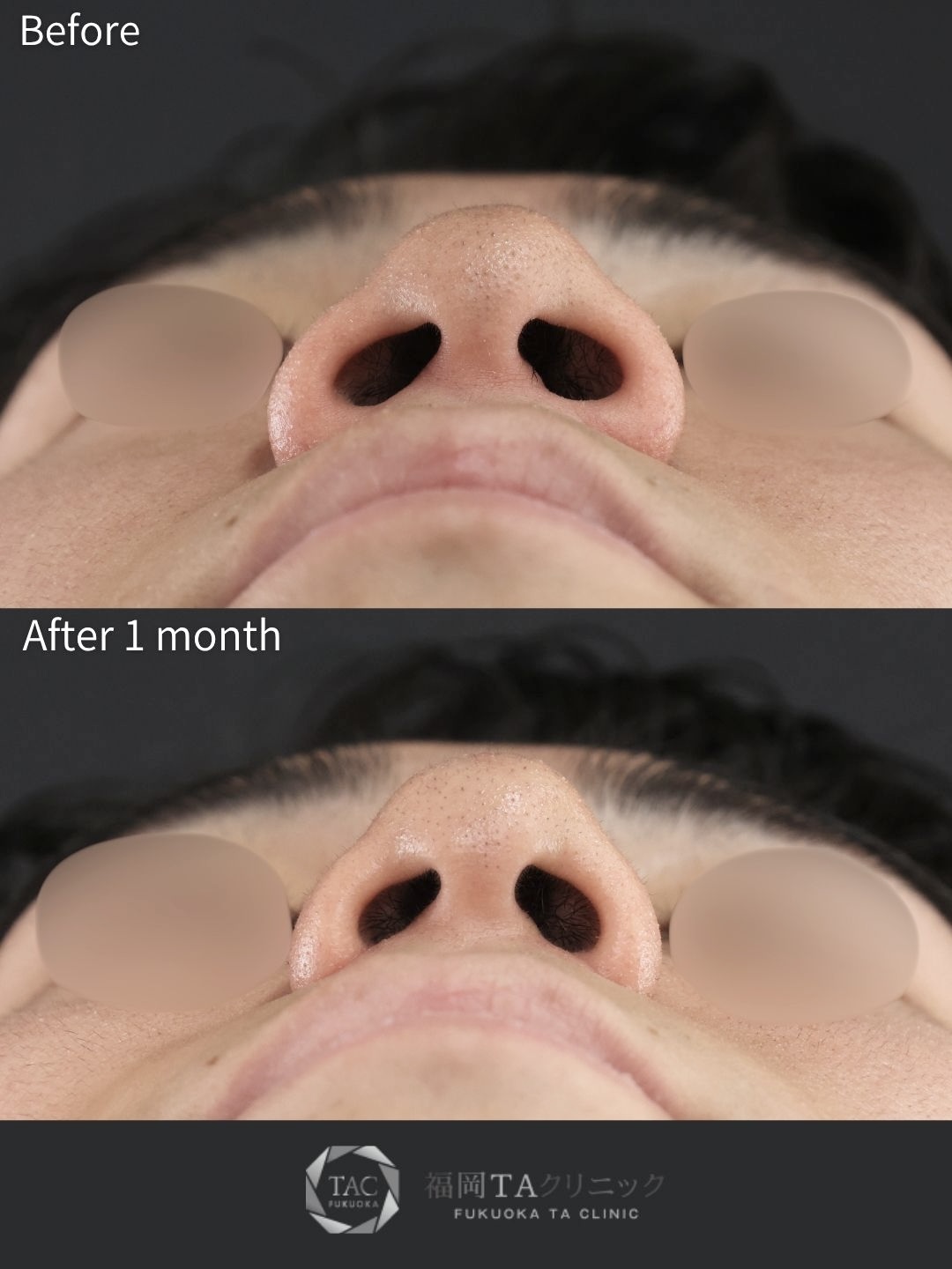 TAC式 鼻翼縮小術（小鼻縮小）の症例写真 施術前後 