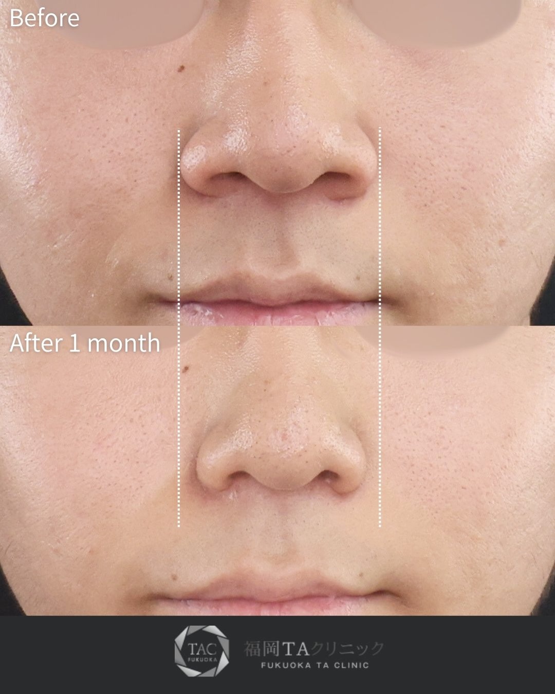 TAC式 鼻翼縮小術（小鼻縮小）の症例写真 施術前後 