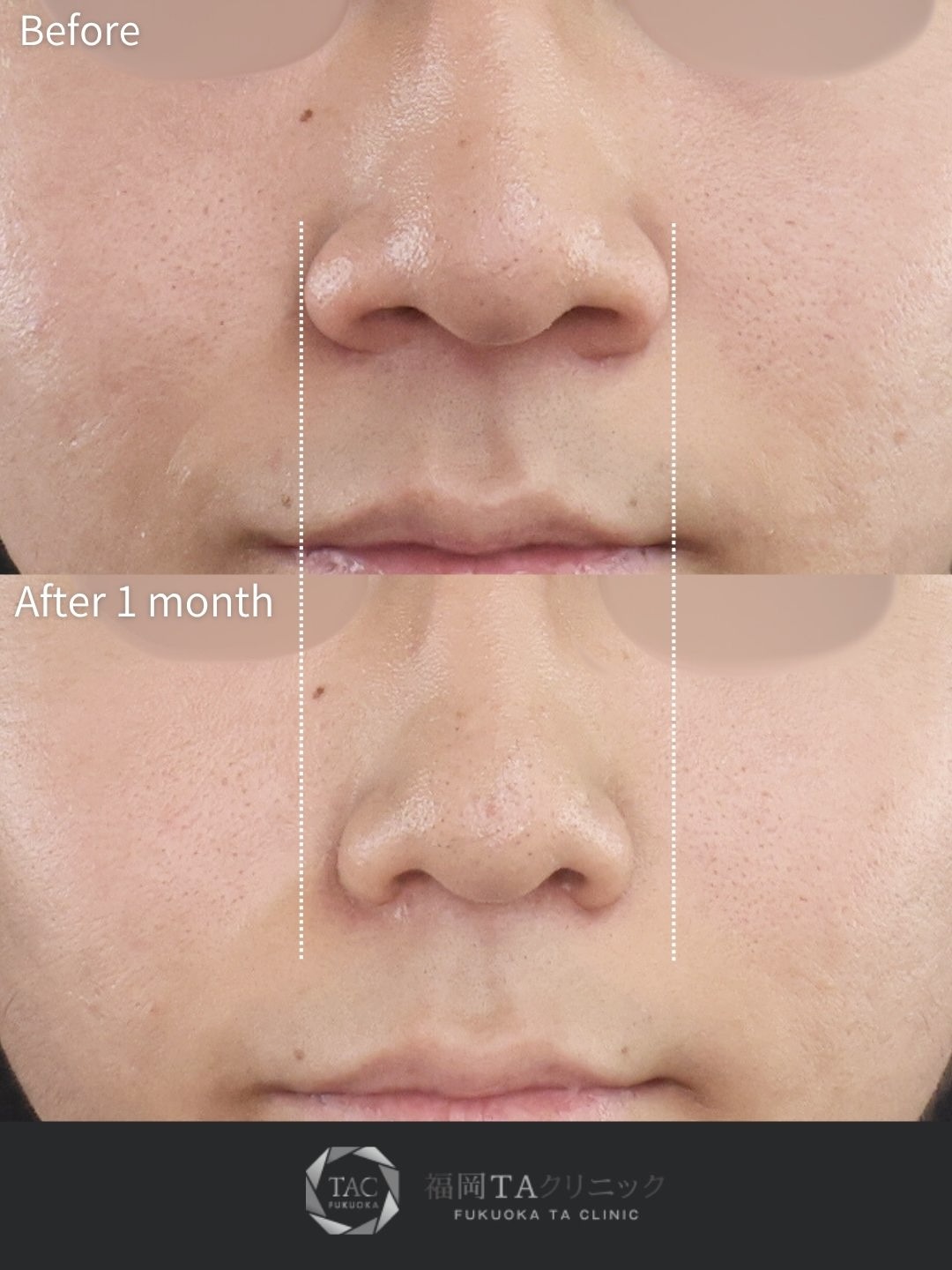 TAC式 鼻翼縮小術（小鼻縮小）の症例写真 施術前後 