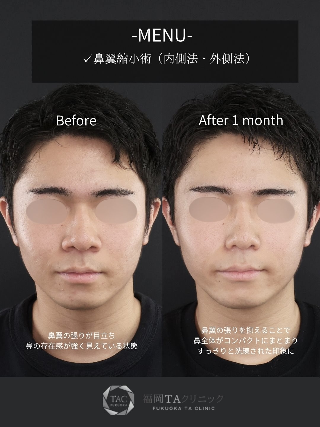 TAC式 鼻翼縮小術（小鼻縮小）の症例写真 施術前後 