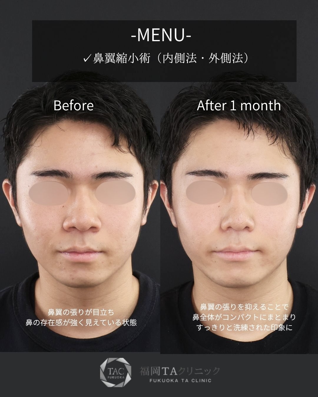 TAC式 鼻翼縮小術（小鼻縮小）の症例写真 施術前後 