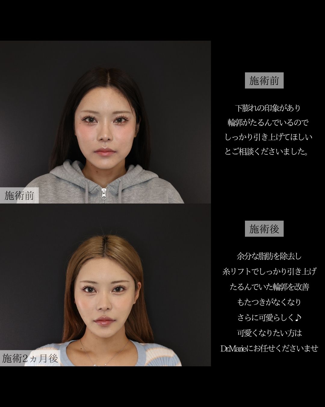 TAC式 ツヤ肌コラーゲンリフト®/Lラインファット除去（エラ下脂肪除去）/ジョールファット除去の症例写真 施術前後 