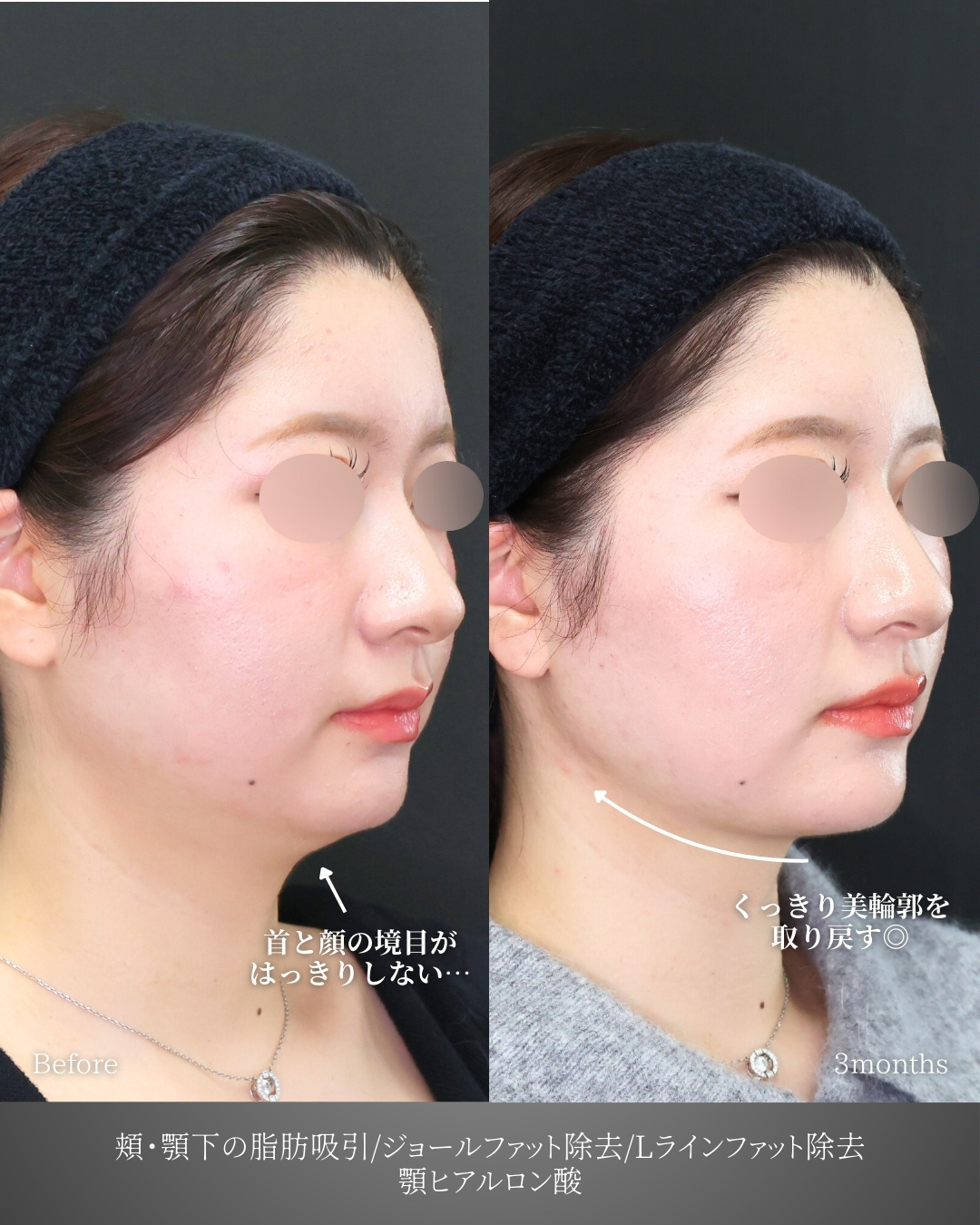 顎下の脂肪吸引・顔の脂肪吸引/ジョールファット除去/Lラインファット除去（エラ下脂肪除去）の症例写真 施術前後 