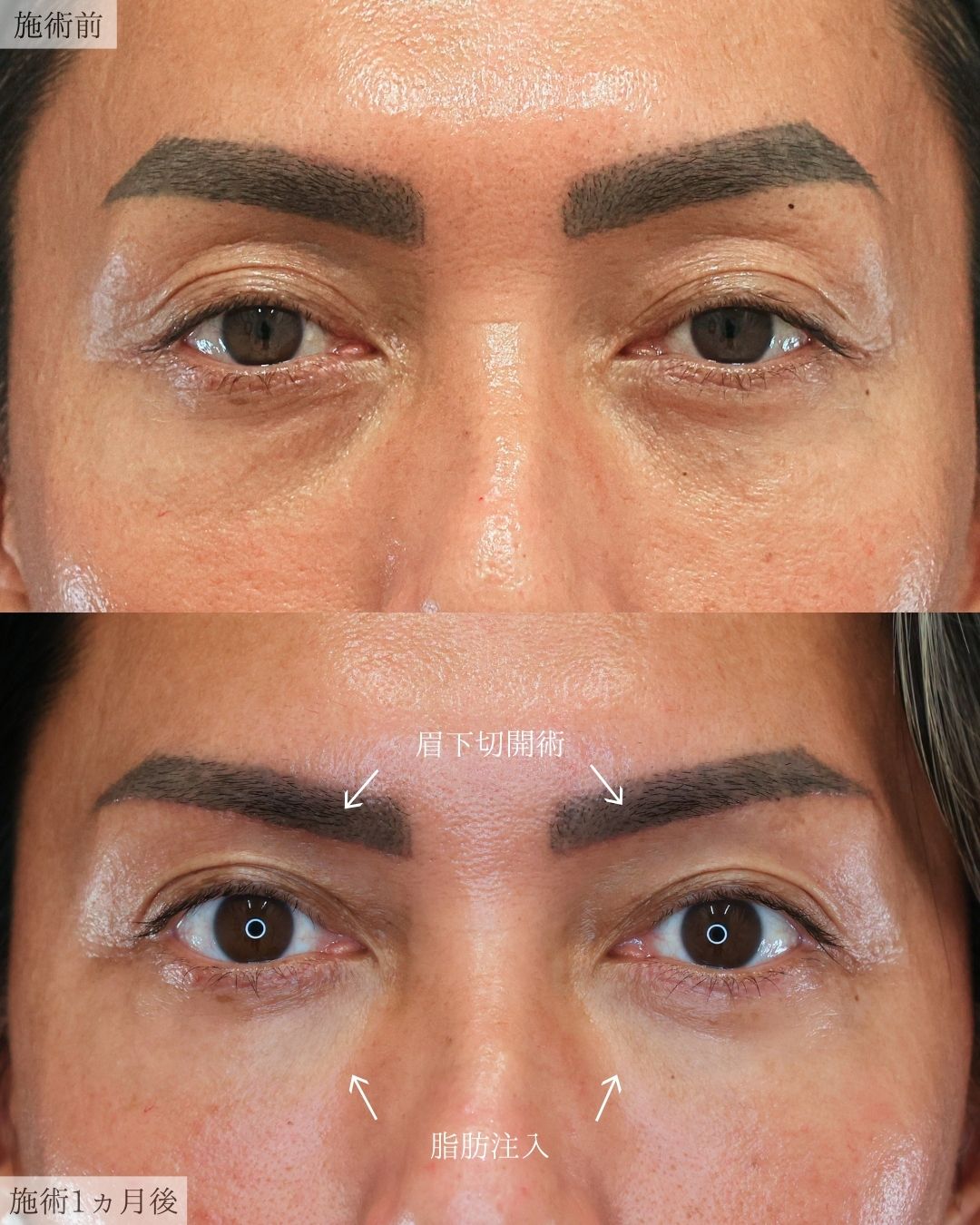 眉毛下切開術/顔の脂肪注入(コンデンスリッチフェイス)の症例写真 施術前後 