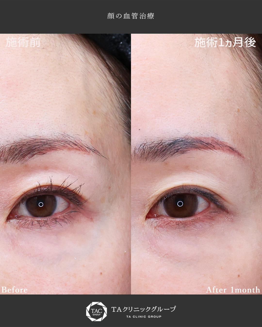 【元心臓血管外科医が執刀】コンシーラーで隠しにくい目の下の血管を改善◎