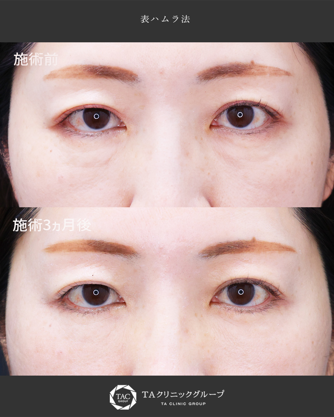 【目の下のたるみ、クマ】原因を見極め、自然に改善。