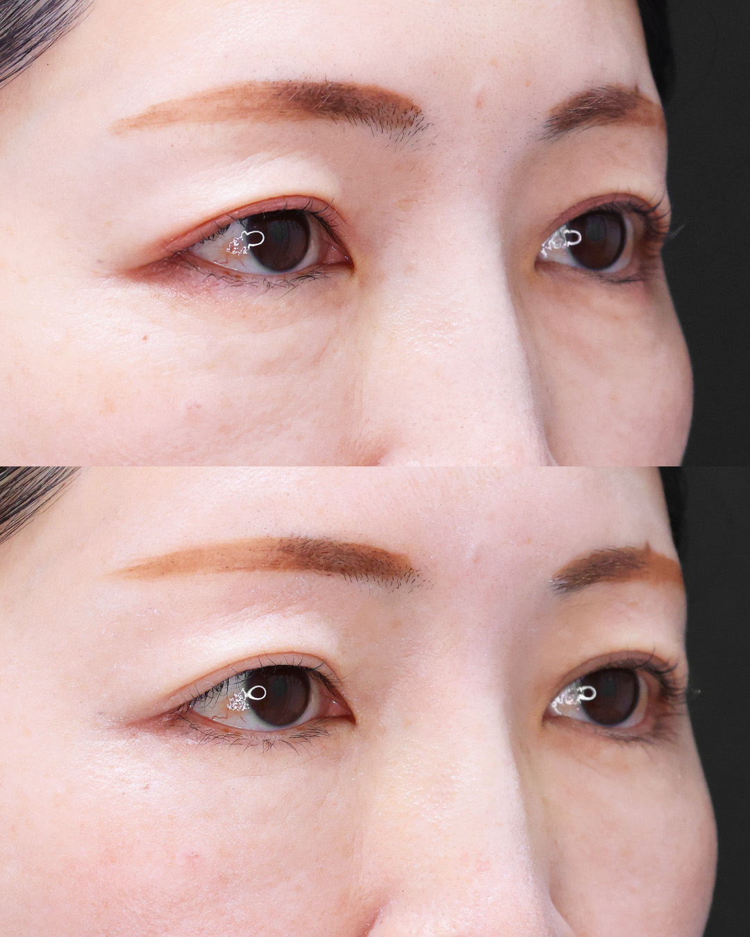 下眼瞼切開術（クマ・たるみとり）/下眼瞼脱脂術（目の下のたるみ取り・目の下の脂肪ふくらみ取り）の症例写真 施術前後 