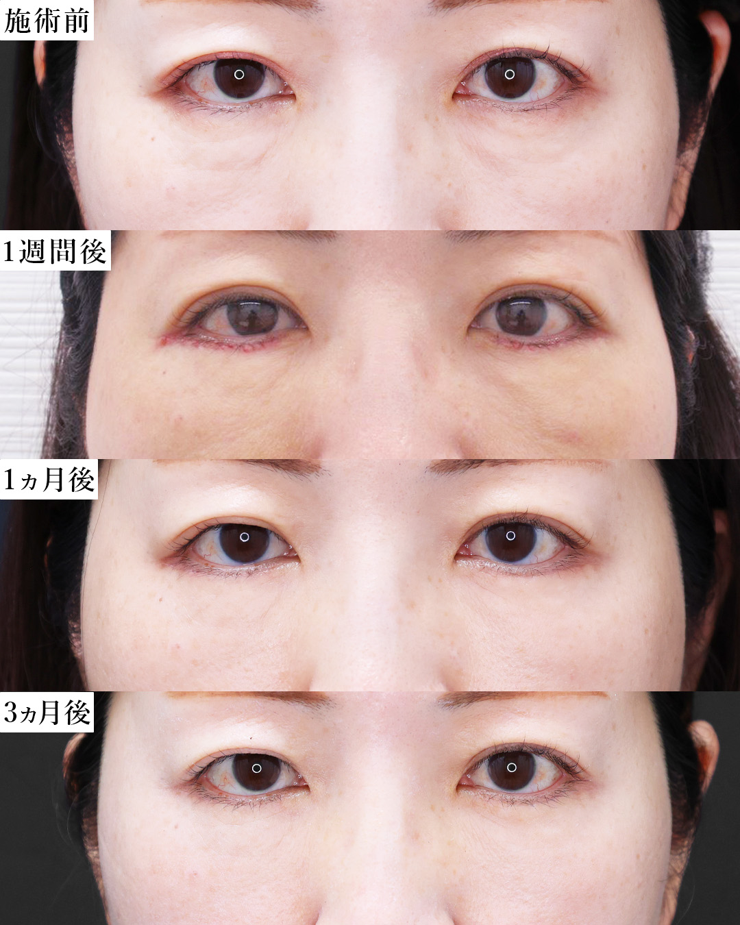 下眼瞼切開術（クマ・たるみとり）/下眼瞼脱脂術（目の下のたるみ取り・目の下の脂肪ふくらみ取り）の症例写真 施術前後 
