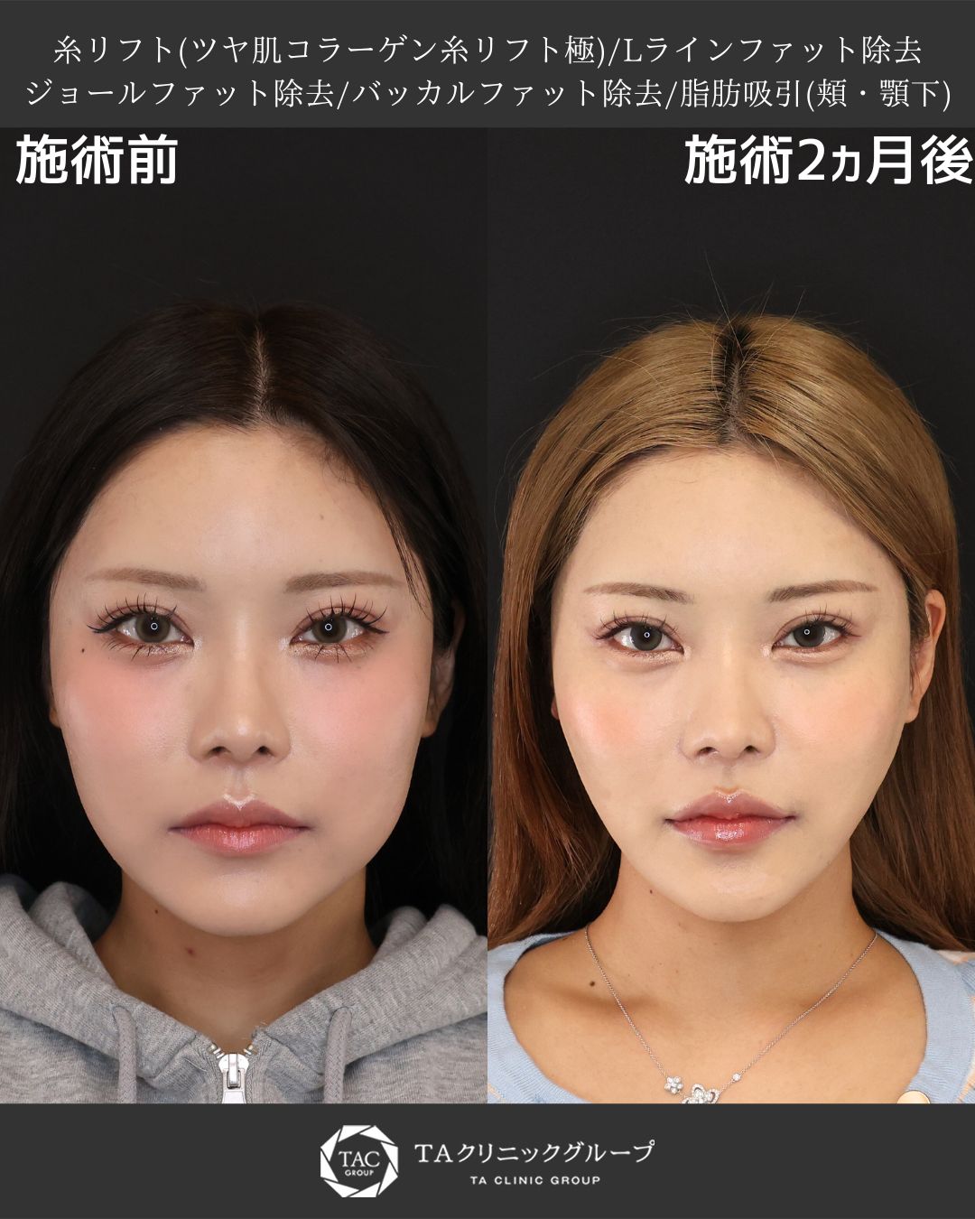 TAC式 ツヤ肌コラーゲンリフト®/Lラインファット除去（エラ下脂肪除去）/ジョールファット除去の症例写真 施術前後 