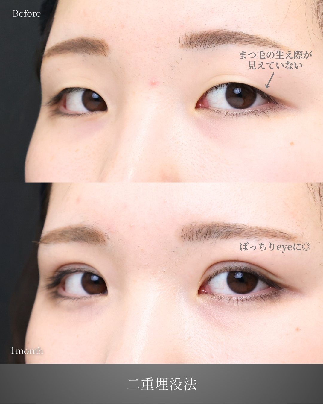 二重埋没法の症例写真 施術前後 