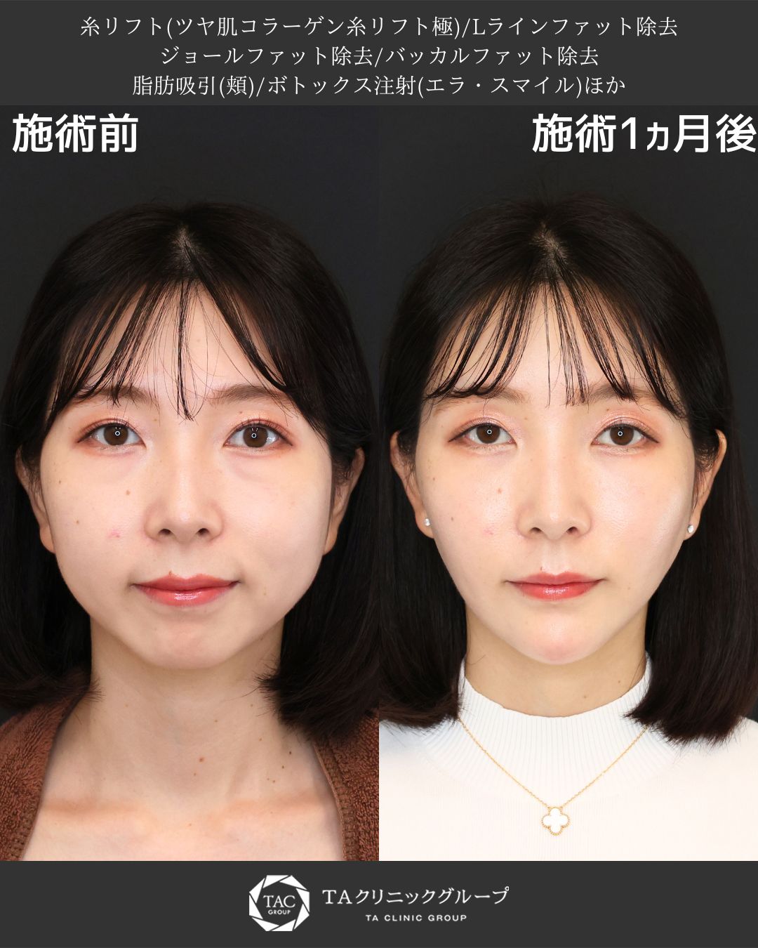 まりえ先生執刀Ⅰたるみ・エラ張り・丸顔をまとめて改善！複合小顔治療