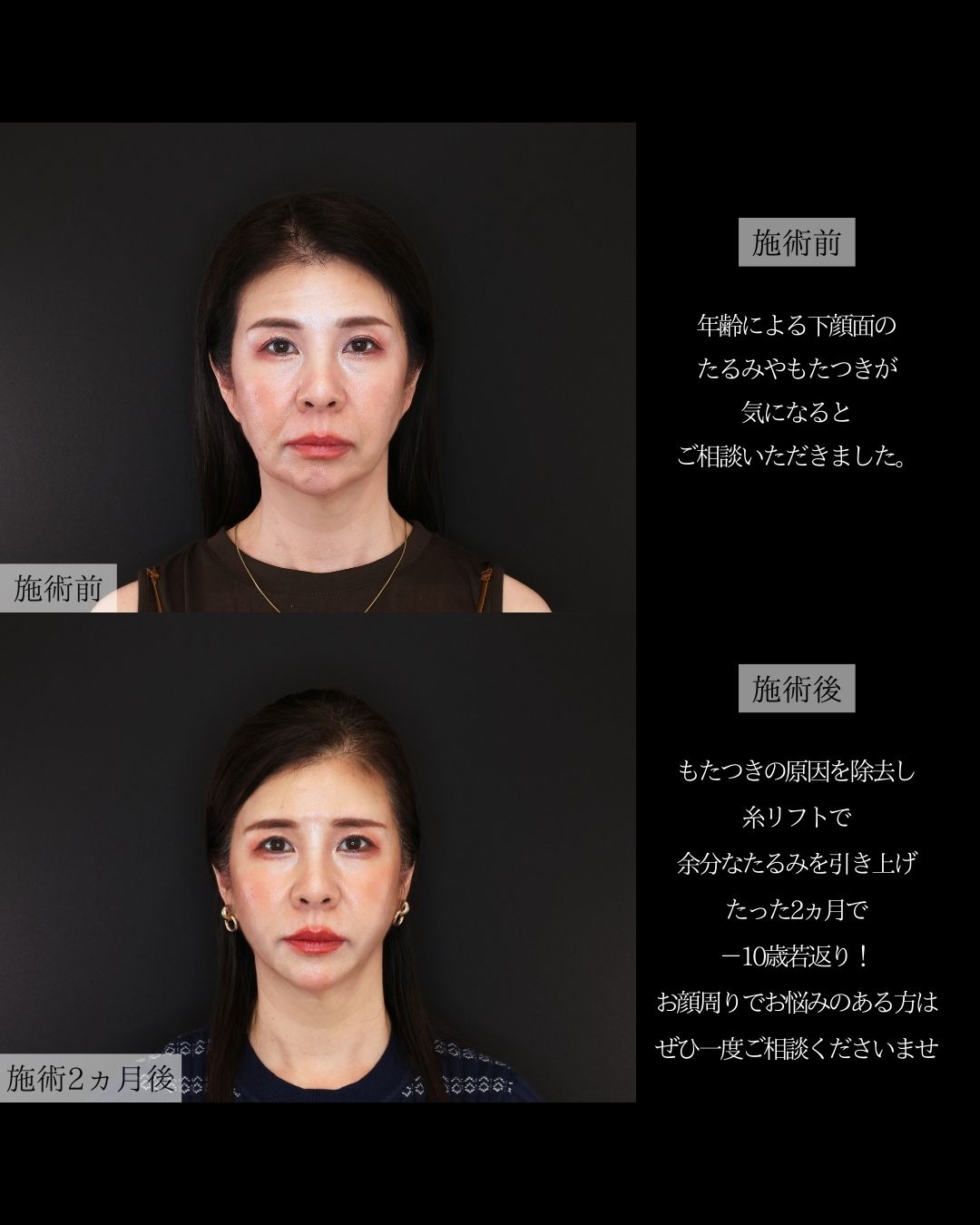 TAC式 ツヤ肌コラーゲンリフト®/Lラインファット除去（エラ下脂肪除去）/ジョールファット除去の症例写真 施術前後 