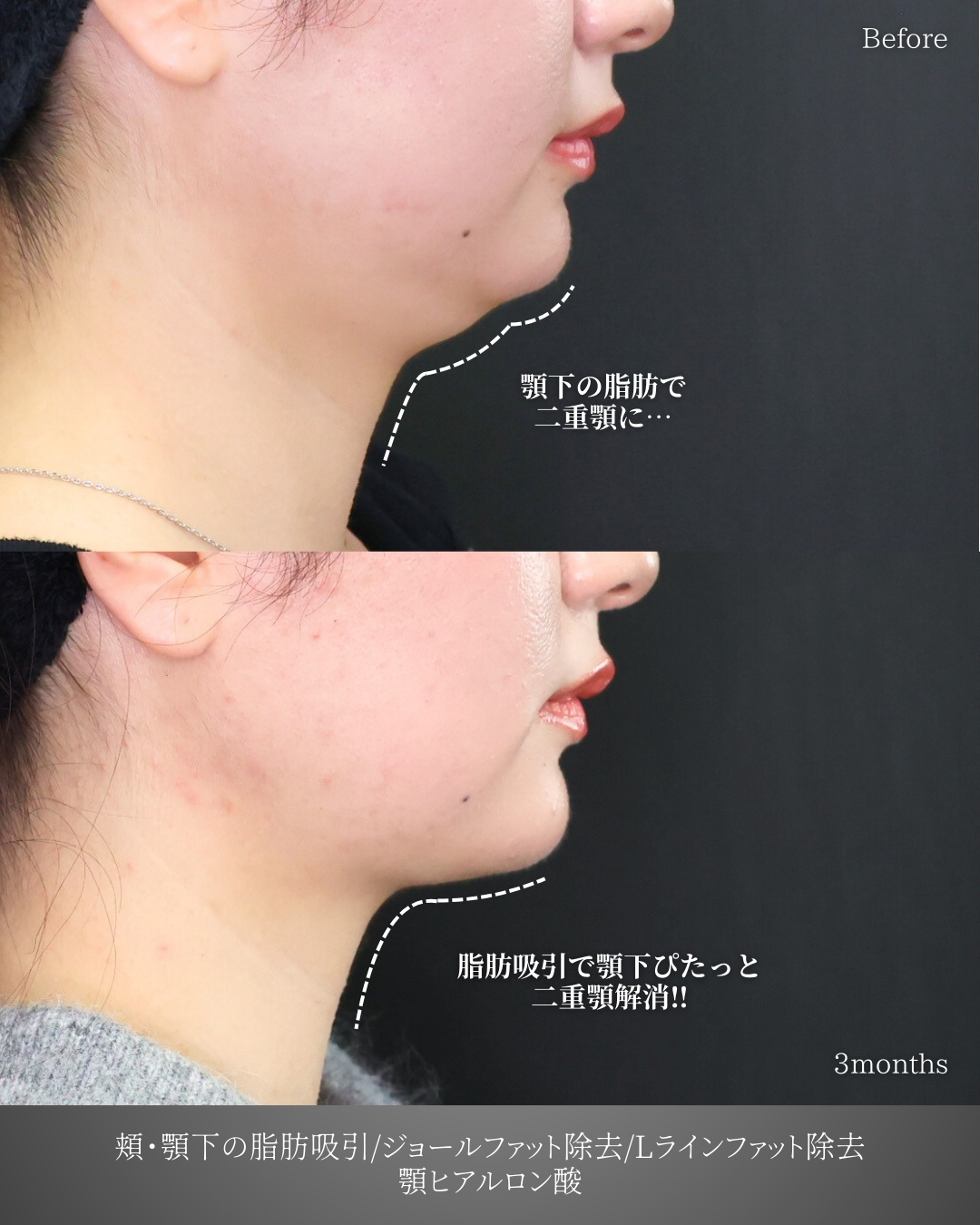 顎下の脂肪吸引・顔の脂肪吸引/ジョールファット除去/Lラインファット除去（エラ下脂肪除去）の症例写真 施術前後 