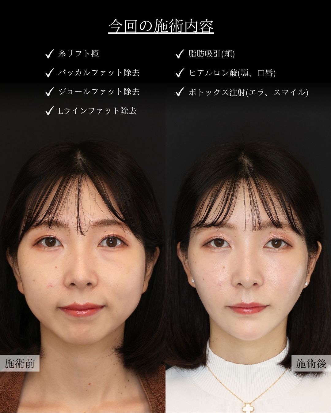 TAC式 ツヤ肌コラーゲンリフト®/Lラインファット除去（エラ下脂肪除去）/ジョールファット除去の症例写真 施術前後 