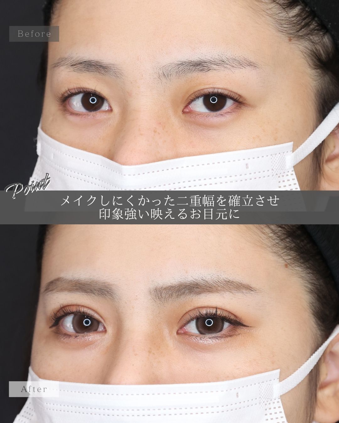 二重埋没法の症例写真 施術前後 