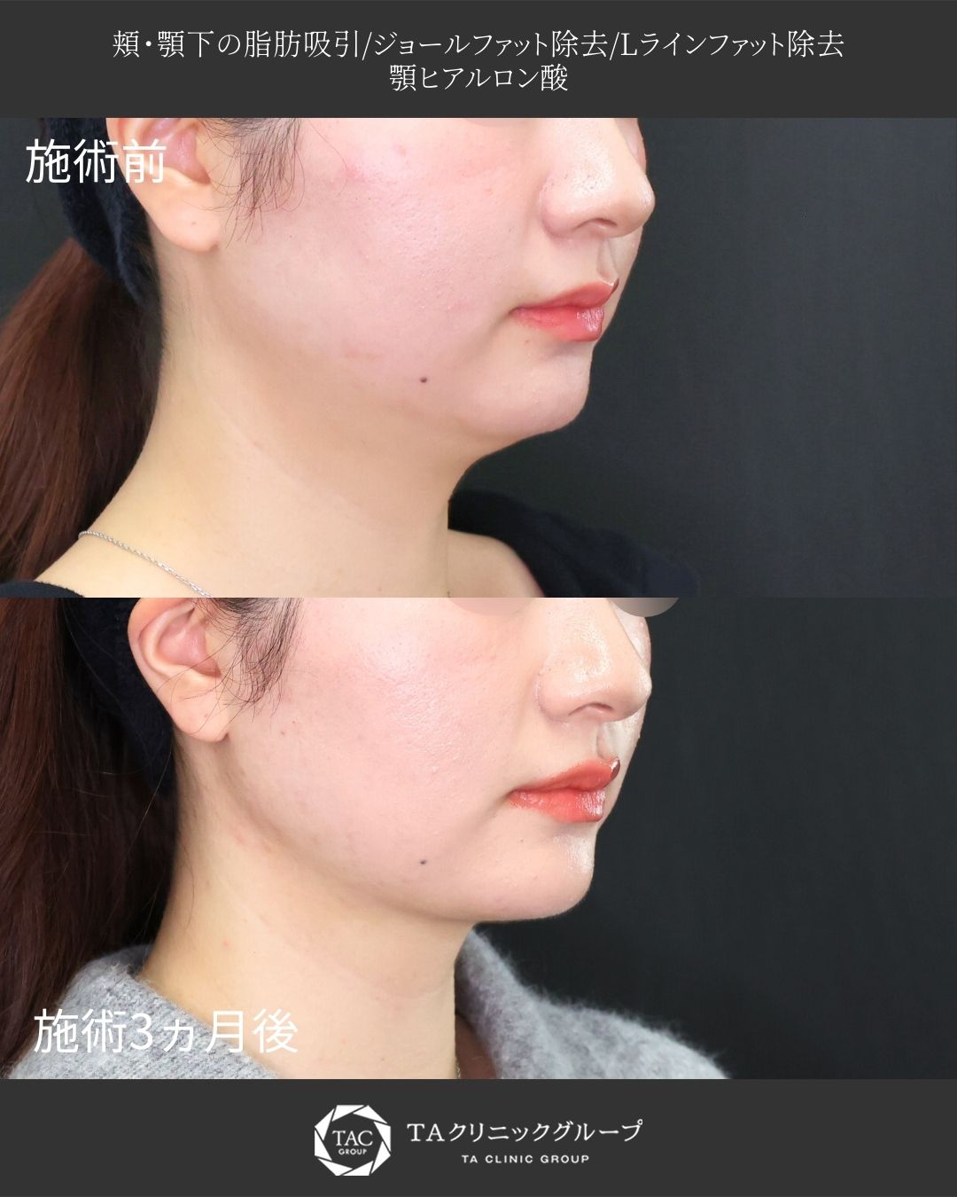 【小顔施術】｜顎下ぴたっと垢抜け輪郭に◎